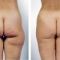 Liposukce