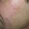 Kwas hialuronowy: Saypha, Restylane, Juvederm, Stylage