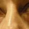 Kwas hialuronowy: Saypha, Restylane, Juvederm, Stylage