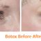 BOTOX® / DYSPORT® - ráncok kisimítása