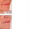 Filler antirughe a base di acido ialuronico