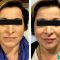 Filler antirughe a base di acido ialuronico