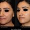 Acne laser, Cicatrici da acne laser