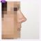 Operácia nosa (Rhinoplastika)