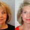 Facelift, SMAS facelifting
