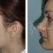Rhinoplasty (Nose Job)