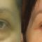 Korekcja powiek (Blepharoplastyka)
