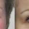 Korekcja powiek (Blepharoplastyka)
