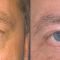 Korekcja powiek (Blepharoplastyka)