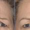 Botulinum toxin - Wrinkle Removal