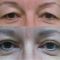 Korekcja powiek (Blepharoplastyka)