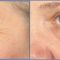 Fractional RF Microneedle