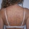 Laserové zákroky estetické dermatologie
