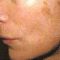 Laserové zákroky estetické dermatologie