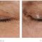 Fractional Laser Resurfacing