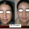 Lipofilling ou autogreffe de tissu graisseux