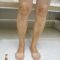 Sclerotization of varicose veins