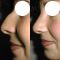 Plastika nosu (Rhinoplastika)