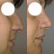 Plastika nosu (Rhinoplastika)