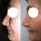 Plastika nosu (Rhinoplastika)