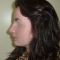 Rhinoplastie