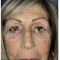 Blépharoplastie inférieure