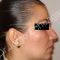 Cirugía de la nariz (Rinoplastia)