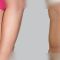 Abdominoplastika (Operace břicha)