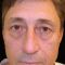 Eyelid surgery (Blepharoplasty)