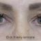 Blépharoplastie inférieure