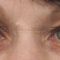 Operácia očných viečok (Blepharoplastika)