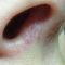 Suppression des veines par laser (taches de naissances, rougeurs)