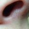 Suppression des veines par laser (taches de naissances, rougeurs)