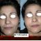 Lipofilling ou autogreffe de tissu graisseux