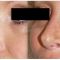 Injections de comblement