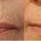 Injections de comblement