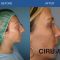 Cirugía de la nariz (Rinoplastia)