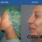 Cirugía de la nariz (Rinoplastia)