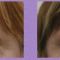 Operace čela (Forehead lift)