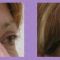 Operace čela (Forehead lift)