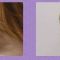 Operace čela (Forehead lift)