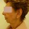 Facelift (operace obličeje), SMAS lifting