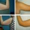 Brahioplastia (Liftingul de brate)