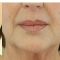 Facelift, SMAS Facelift