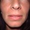 Filler antirughe a base di acido ialuronico