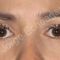 Cirugía de párpados (Blefaroplastia)