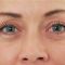 Hyaluronic acid-based wrinkle fillers