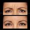 Botox/Dysport - Eliminar arrugas