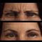 Botox/Dysport - Eliminar arrugas
