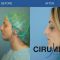 Cirugía de la nariz (Rinoplastia)